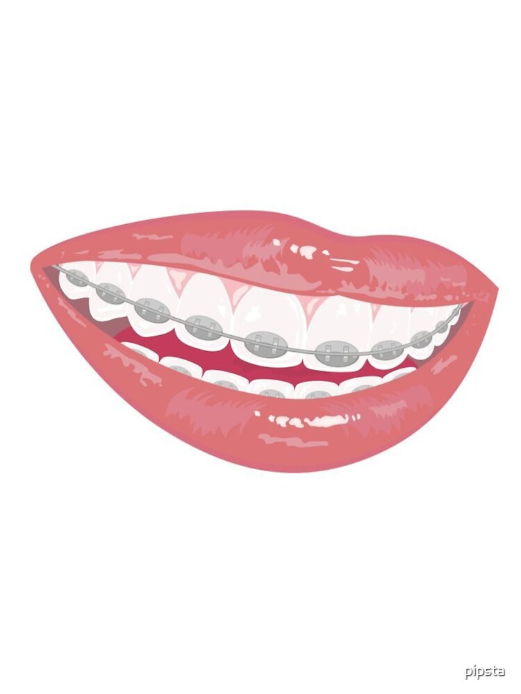 Braces by Sipsta